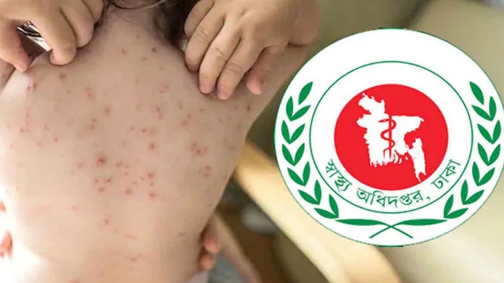 সারাদশে ২৪ ঘণ্টায় হামের উপসর্গে ৪ শিশুর মৃত্যু