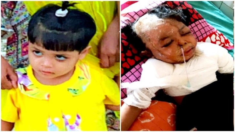 ফতুল্লায় ফুটন্ত পানিতে জ্বলসে গেলো শিশুর মুখ