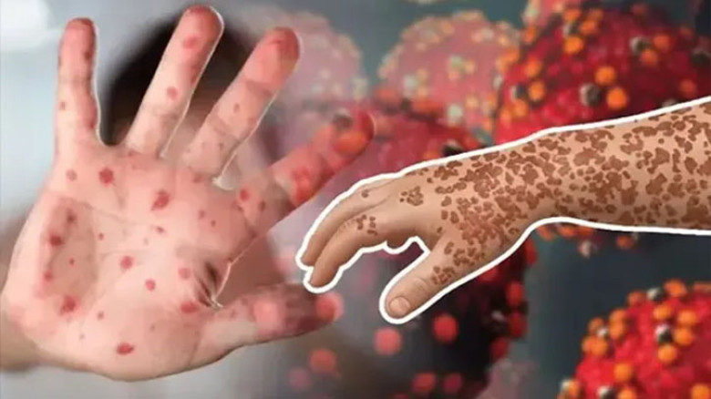 হাম ও হামের উপসর্গে আরও ৭ শিশুর মৃত্যু