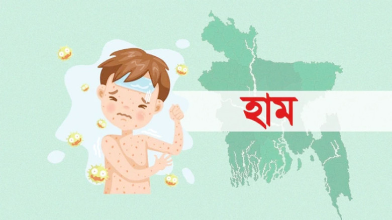 দেশে হাম ও উপসর্গে আরও ৬ শিশুর মৃত্যু