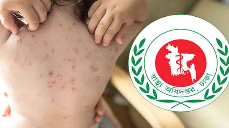সারাদেশে হাম উপসর্গে আরও তিন শিশুর মৃত্যু