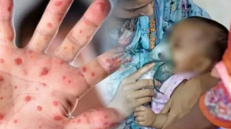 দেশে ২৪ ঘণ্টায় হাম ও উপসর্গে আরও ৫ শিশুর মৃত্যু, আক্রান্ত ৯৬৯
