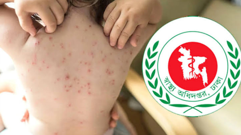 দেশে হামের উপসর্গে আরও ৮ জনের মৃত্যু