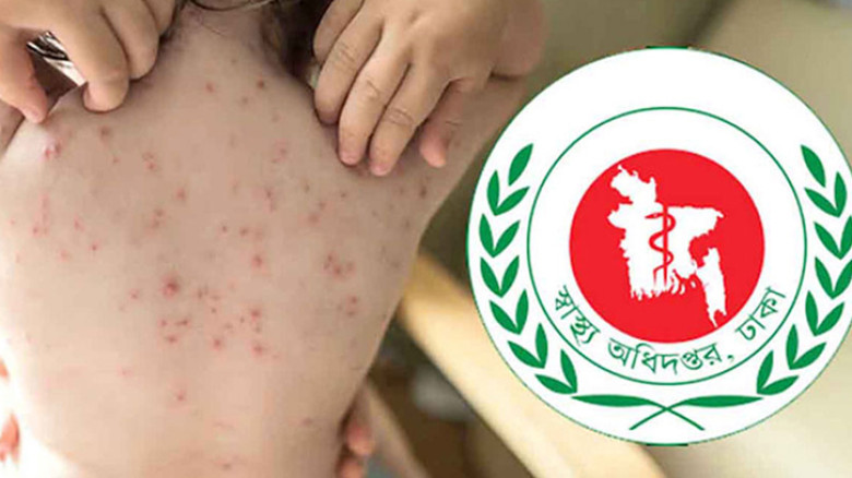 সারাদেশে ২৪ ঘণ্টায় হাম উপসর্গে ২ জনের মৃত্যু