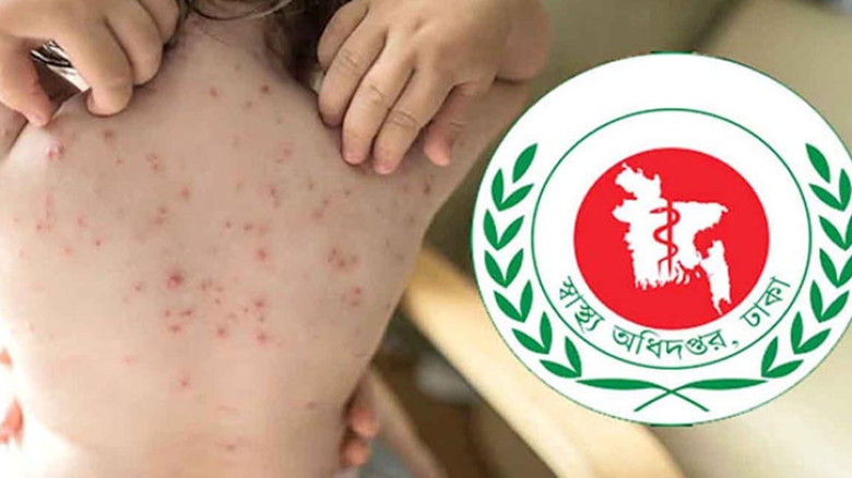 সারাদেশে হামের উপসর্গে আরও ৫ শিশুর মৃত্যু